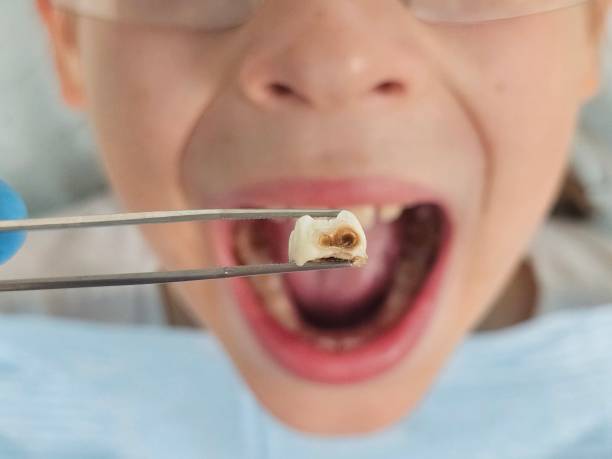 Best Knocked-Out Tooth (Avulsed Tooth) Treatment in Whitewater, KS